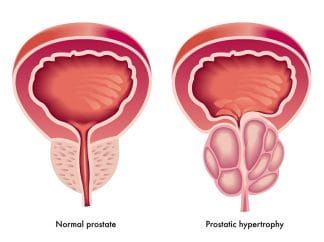  hypertrofi av prostatakörteln